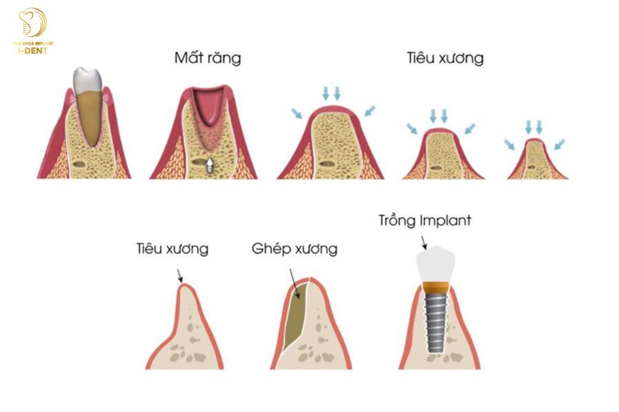 Vì sao nên phục hình răng giả?