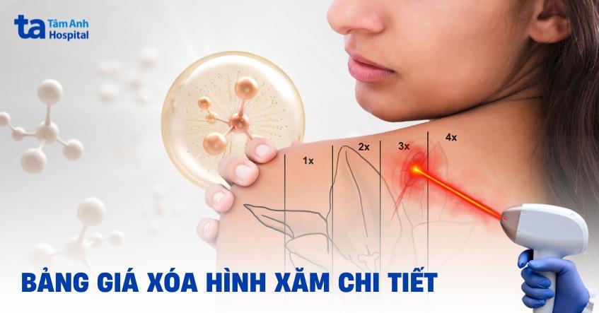 xóa hình xăm bao nhiêu tiền